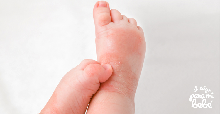 ¿Alergias en la piel de los niños?: Conoce 3 tipos: Urticaria - Childy's Para mi bebé