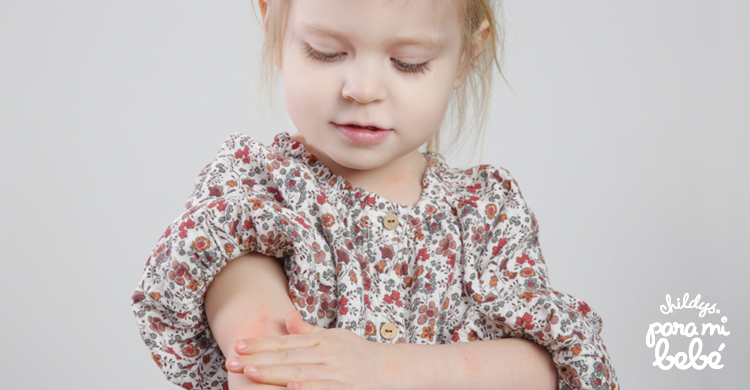 ¿Alergias en la piel de los niños?: Conoce 3 tipos - Childy's Para mi bebé